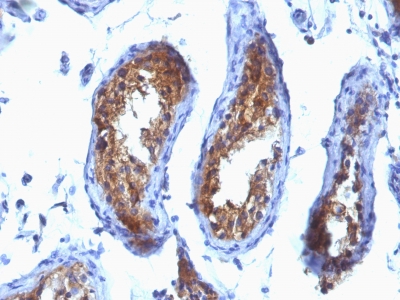 FFPE human testicular carcinoma sections stained with 100 ul anti-Major Vault Protein (clone SPM280) at 1:300. HIER epitope retrieval prior to staining was performed in 10mM Tris 1mM EDTA, pH 9.0.
